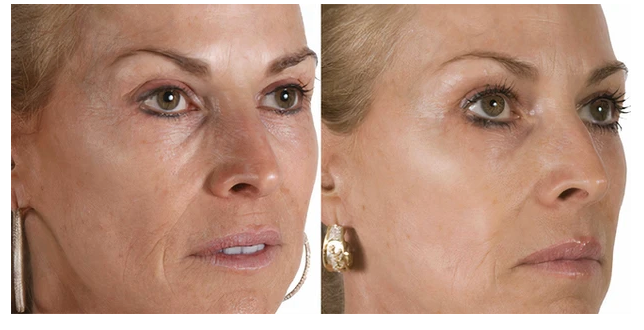 AnteAGE MD System with Biosomes (Serum & Accelerator)