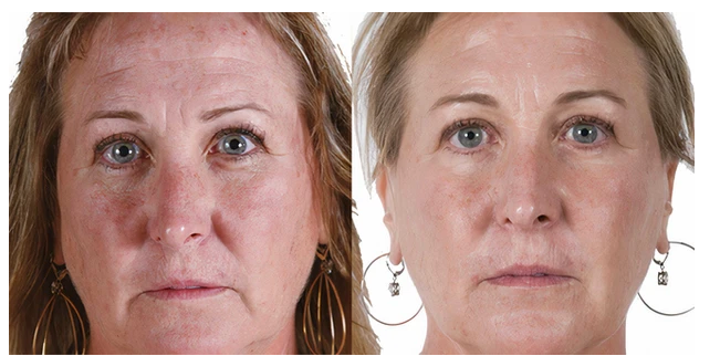 AnteAGE MD System with Biosomes (Serum & Accelerator)