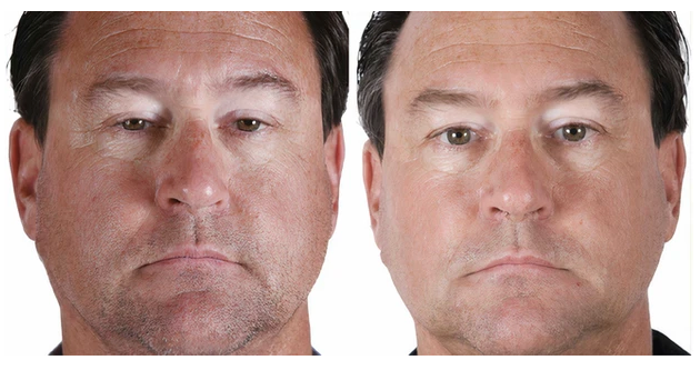 AnteAGE MD System with Biosomes (Serum & Accelerator)