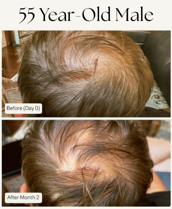 Xtresse Hair Growth Gummies (3-month supply)