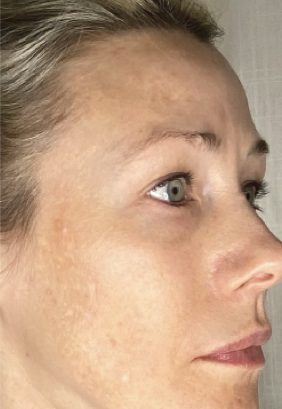 AnteAGE MD Brightening Microneedling+