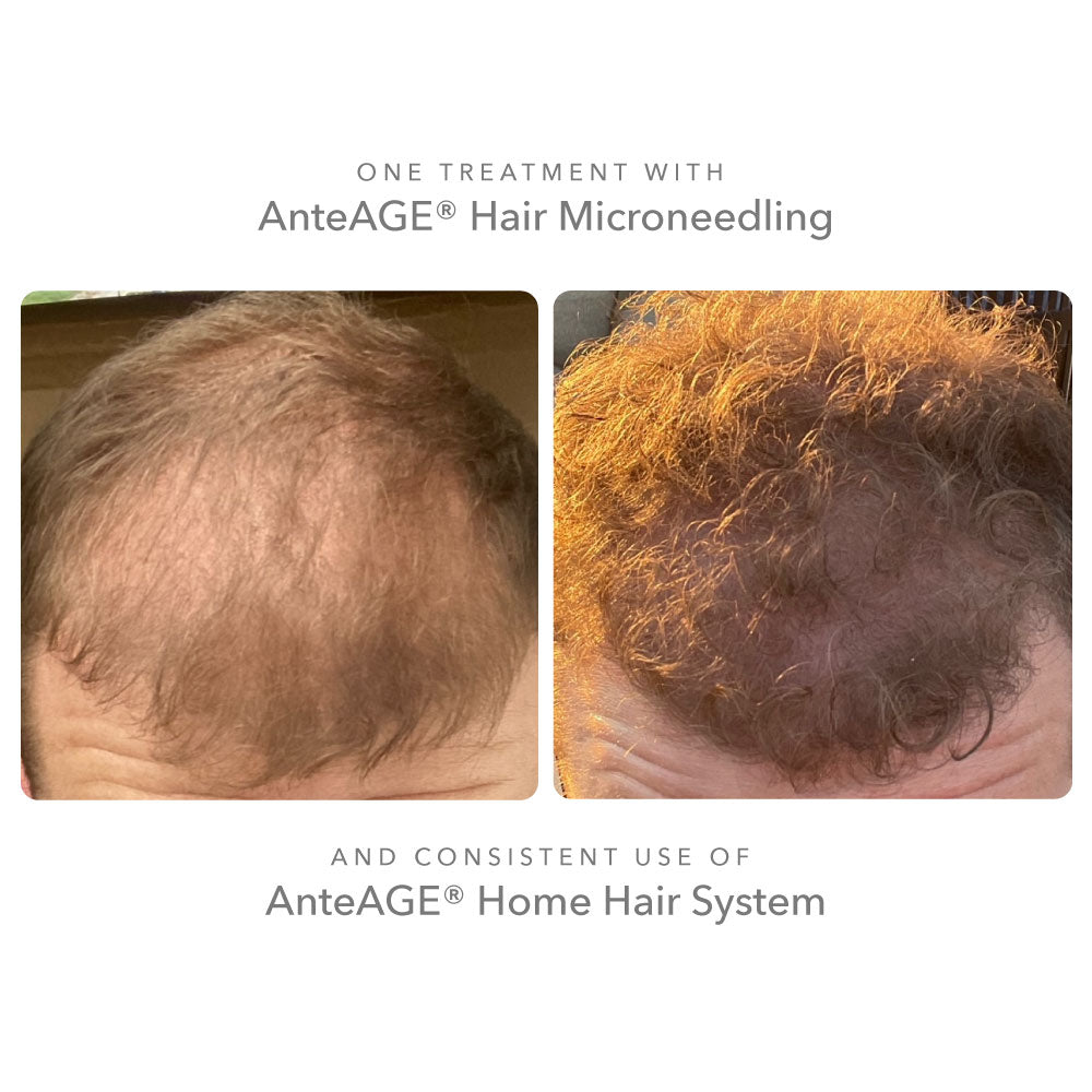 AnteAGE MD Pro Hair Microneedling Solution