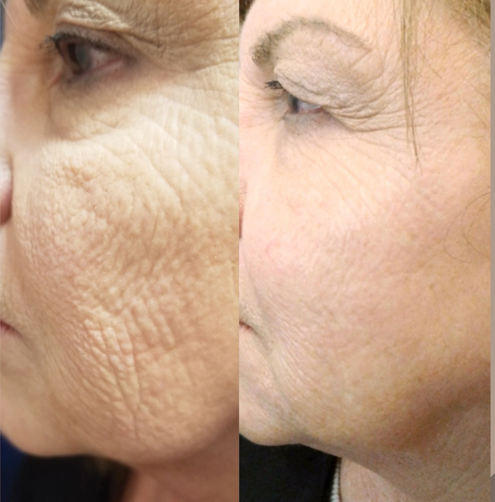 AnteAGE MD Growth Factor Microneedling+