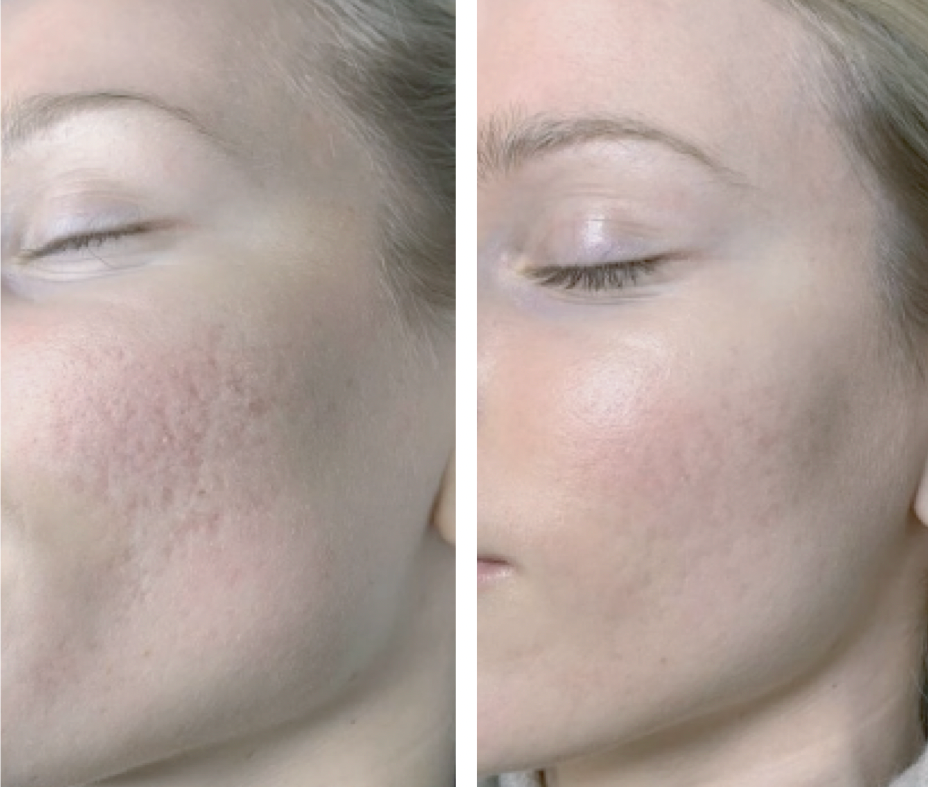 AnteAGE MD Growth Factor Microneedling+