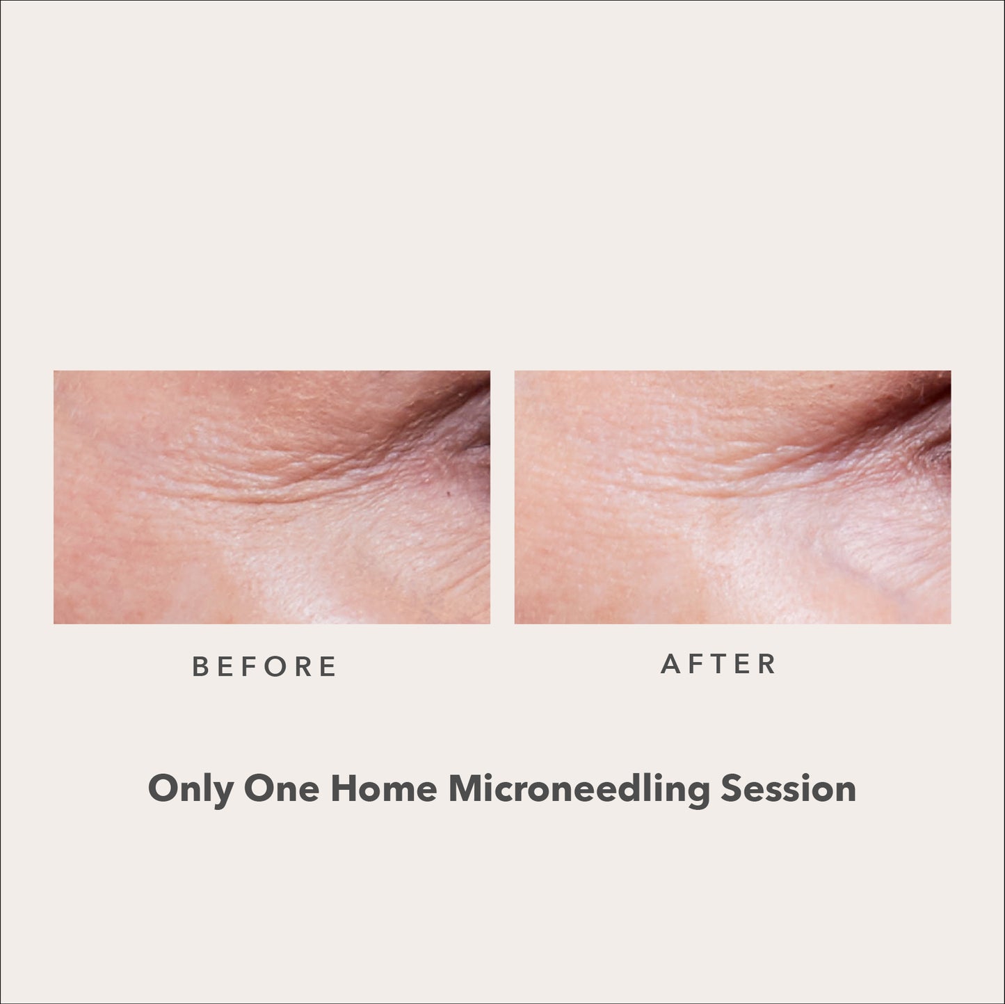 AnteAGE Home Microneedling System